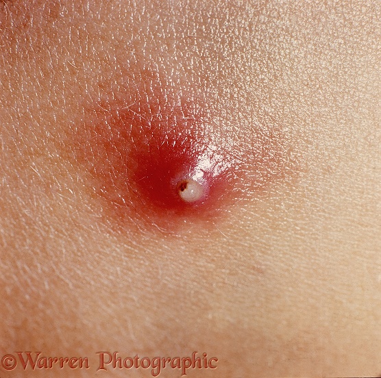 "Warble" caused by larva of Tumbu Fly (Cordylobia anthropophaga) beneath the skin of a child's back.  Africa